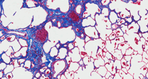 Idiopathic pulmonary fibrosis (IPF)